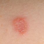 Natural Remedies Using Essential Oils for Ringworm Natural Remedies Using Essential Oils for Ringworm