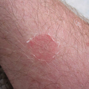 Oils for Ringworm