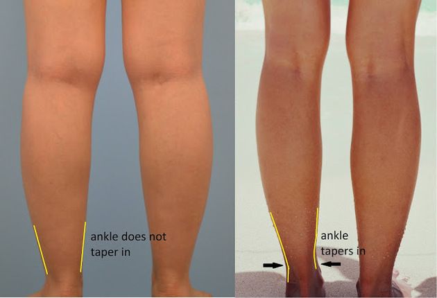 Ways to Get Rid of Cankles