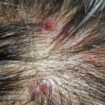 Scalp Scabs: Causes, Symptoms and How to Heal Scalp Scabs
