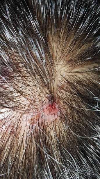 Scalp Scabs: Causes, Symptoms and How to Heal