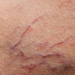 How To Get Rid of Broken Capillaries on Face? Broken Capillaries on Face