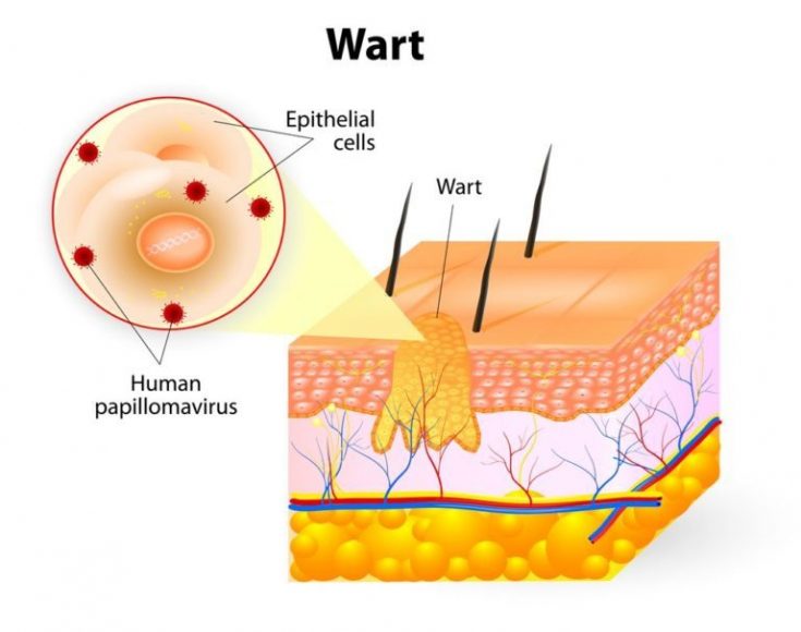 Genital wart is another STDs that can be confused with Fordyce spots