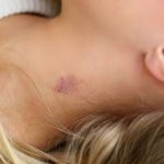 Home Remedies for Hickeys That You Have to Know Last Minute Home Remedies for Hickeys