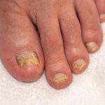 Thick Toenails: Causes & Treatment (Home Remedies) Thick Toenails
