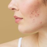 10 Home Remedies for Acne Scars Removal acne scars removal