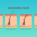 Difference Between Ingrown Hair and Herpes Difference Between Ingrown Hair and Herpes