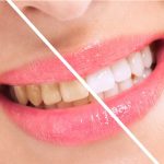 How to Get Rid of Yellow Teeth How to Get Rid of Yellow Teeth
