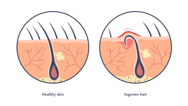 Ingrown hair