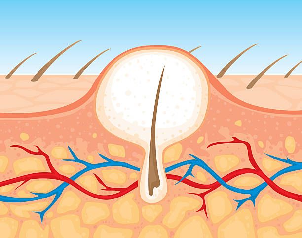 ingrown hair