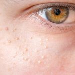 How to Get Rid of Milia – What Happens With 22 Guide Tips to A Perfect Skin How to Get Rid of Milia