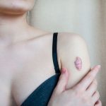 How to Get Rid of a Keloid Scar How to Get Rid of a Keloid Scar