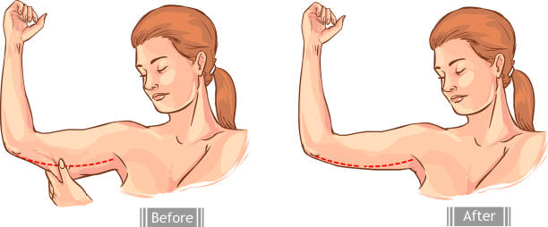 Lose Arm Fat