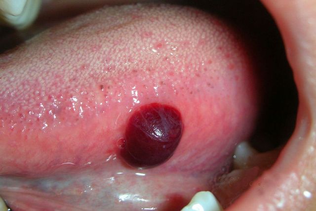 Blood Blister In Mouth: Causes, Symptoms, And Treatments