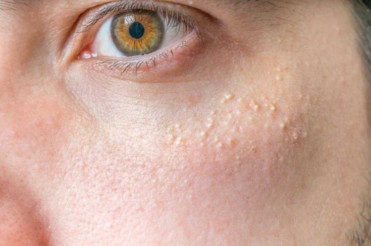Calcium deposit around the eyes