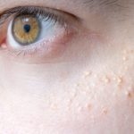 How to Get Rid of Calcium Deposits on Face, Around The Eyes, Teeth and Tendon How To Get Rid Of Calcium Deposits On Face