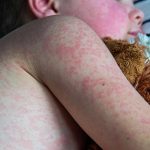 Home Remedies for Measles