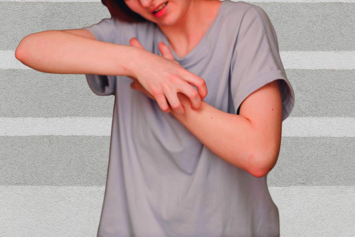 Home Remedies for Scabies