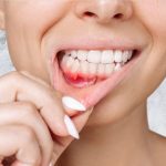 Home Remedies for Bleeding Gums Home Remedies for Bleeding Gums