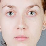 How to Get Rid of Blemishes