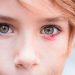 Amazing Tips on How to Get Rid of Blepharitis How to Get Rid of Blepharitis