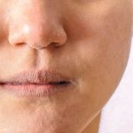 20 Natural Home Remedies for Peeling Skin Home Remedies for Peeling Skin