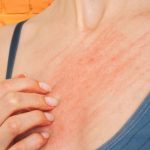 How to Get Rid of Rash Under Breast How to Get Rid of Rash Under Breast