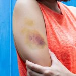 How to Treat a Hematoma With 30 Effective Ways How to Treat a Hematoma