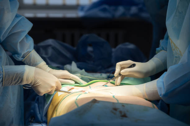 Tummy Tuck Safety Considerations