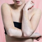 Home Remedies for Tinea Versicolor You Need to Know to Make You Beautiful Again Home Remedies for Tinea Versicolor