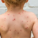 How to Get Rid of Chicken Pox and Every Thing About Chickenpox how to get rid of chicken pox