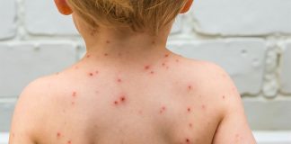 How to Get Rid of Chicken Pox and Every Thing About Chickenpox how to get rid of chicken pox