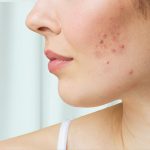 Home Remedies for Acne Scars