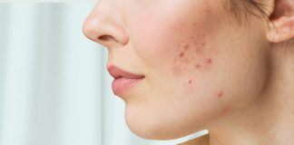 Home Remedies for Acne Scars