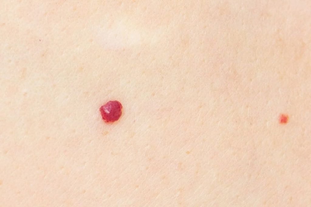 Cherry Angioma Removal At Home: Causes, Symptoms, and Treatments