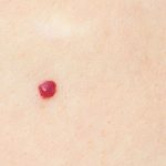 Cherry Angioma Removal At Home: Causes, Symptoms, and Treatments Cherry Angioma Removal