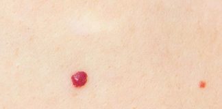 Cherry Angioma Removal At Home: Causes, Symptoms, and Treatments Cherry Angioma Removal