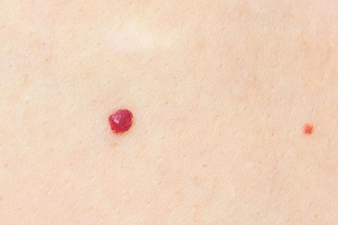 Cherry Angioma Removal