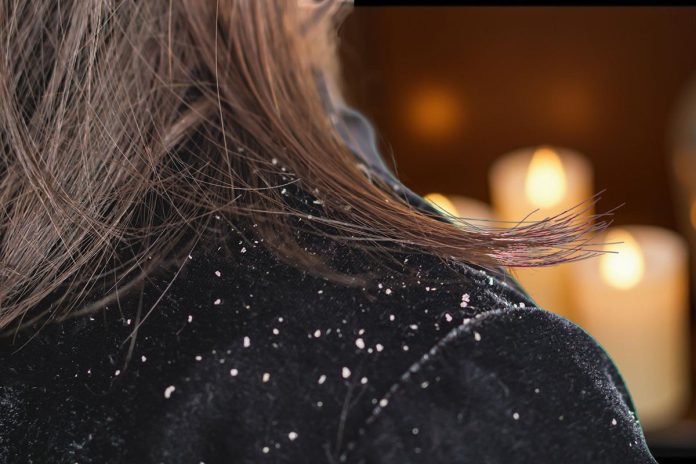 Essential Oils For Dandruff