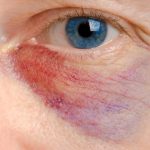 How to Get Rid of a Black Eye – 22 Most Handy Tips To Learn How To Get Rid of a Black Eye