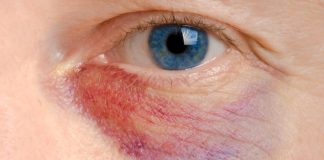How to Get Rid of a Black Eye – 22 Most Handy Tips To Learn How To Get Rid of a Black Eye