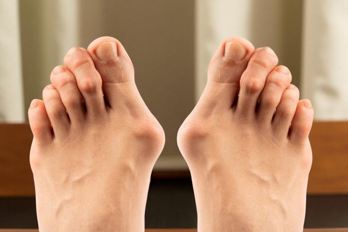 How to Get Rid of a Bunion