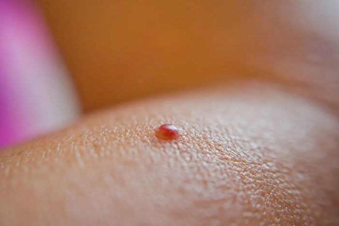 How to remove cherry angiomas