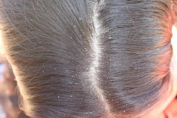 What Is Dandruff