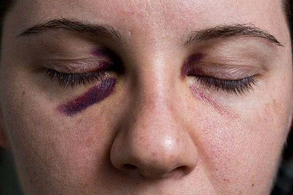 What causes Black Eye