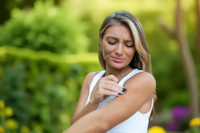 Home Remedies For Mosquito Bites