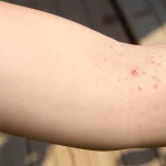 Top 19 Natural Home Remedies for Molluscum Contagiosum Amazing You Home Remedies for Molluscum Contagiosum