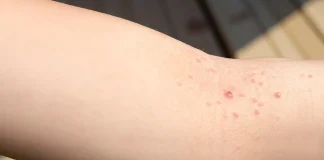 Top 19 Natural Home Remedies for Molluscum Contagiosum Amazing You Home Remedies for Molluscum Contagiosum