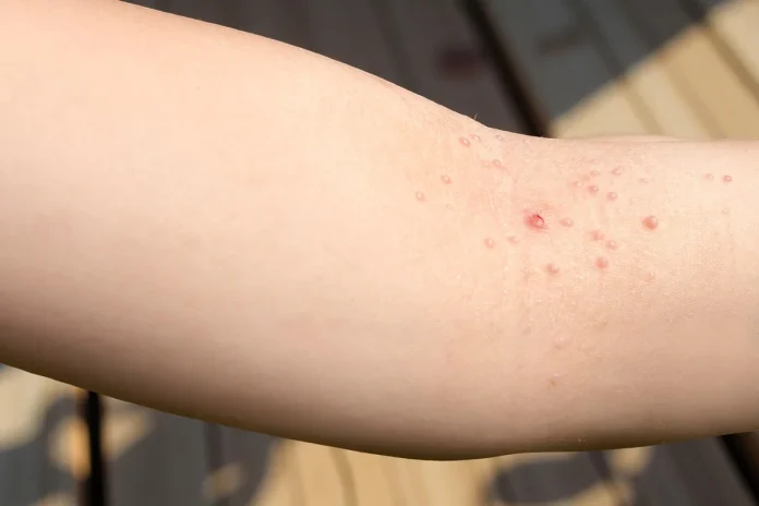 Home Remedies for Molluscum Contagiosum