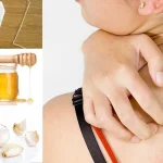 Home Remedies for Shingles Home Remedies for Shingles